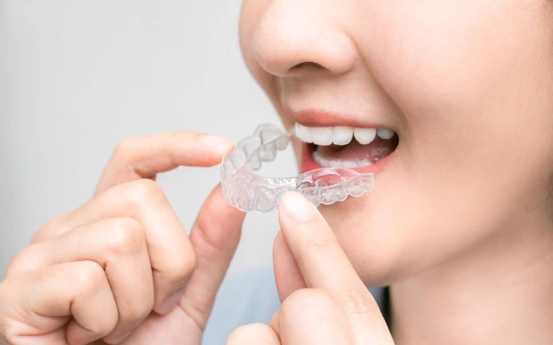 Woman inserting Invisalign Clear Aligners in Columbus OH