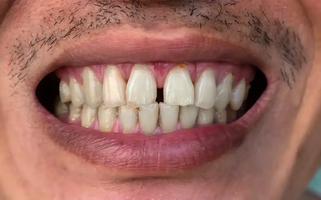 How Do Dentists Fix Gaps in Front Teeth?